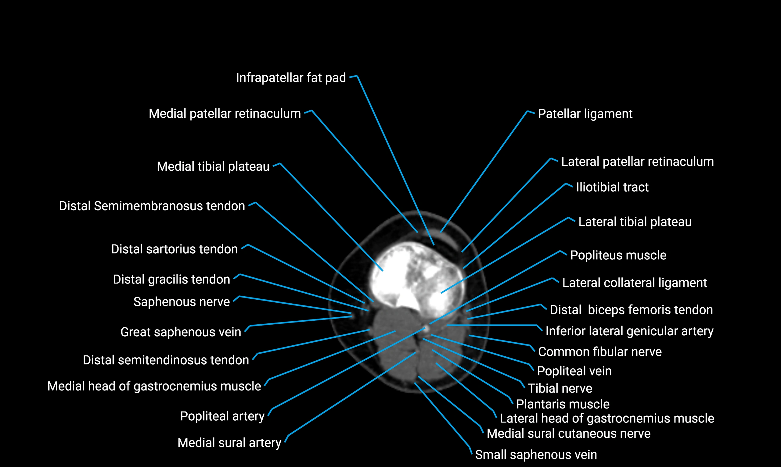 CT thigh axial cross sectional anatomy labelled image_92 (2).webp